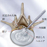 PELD手術方法 図